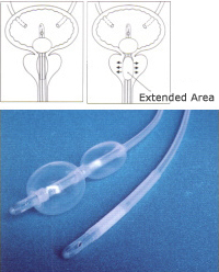 DIB Balloon Catheter Double-Balloon Type